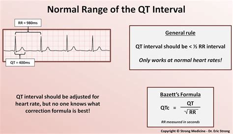 QT Interval