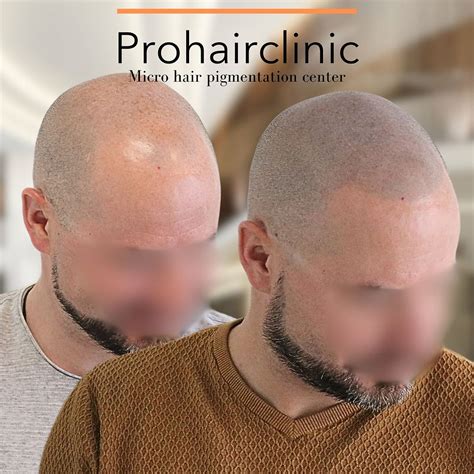 Quality of Pigmentation