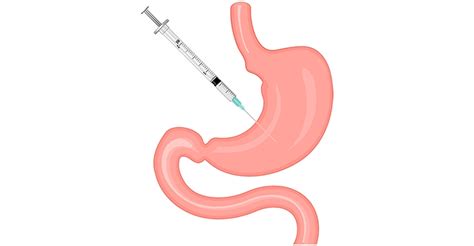 Magen Botox – FairyMed