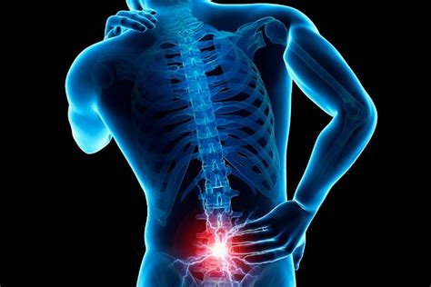 La lumbalgia y la ciática: causas, síntomas y tratamiento - Osium Trauma