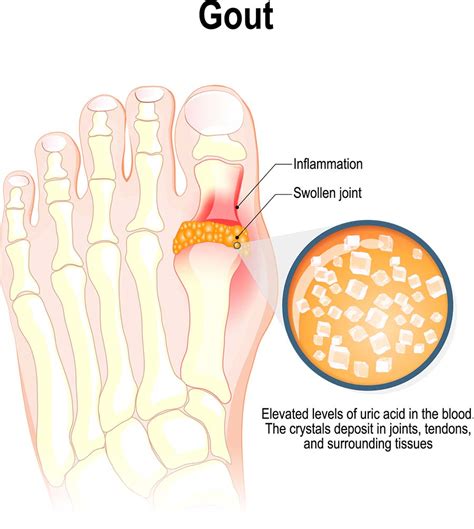 R.I.C.E. Modification for Gout