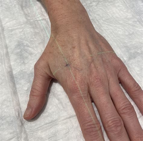 Radiation Treatment Tattoo