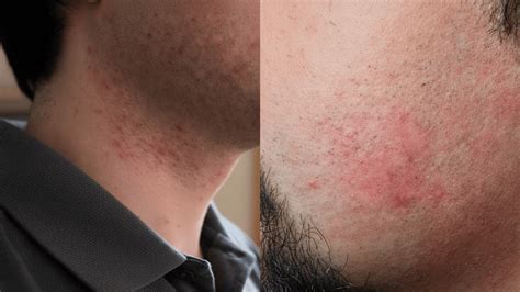 Razer Bumps