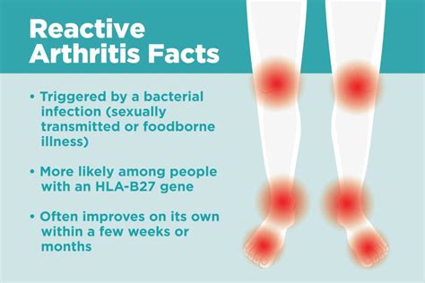 What Is Reactive Arthritis? Understanding Symptoms, Causes, and Treatment