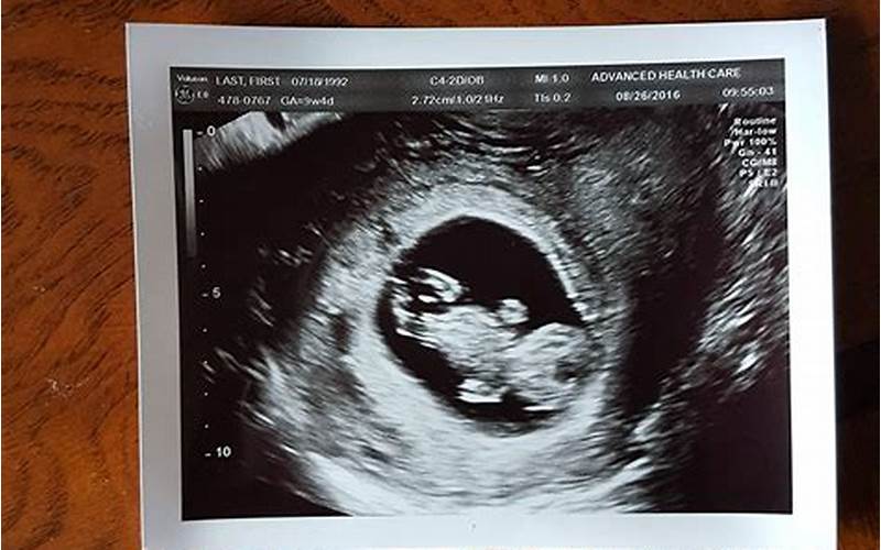 Reasons For Fake Ultrasound Images