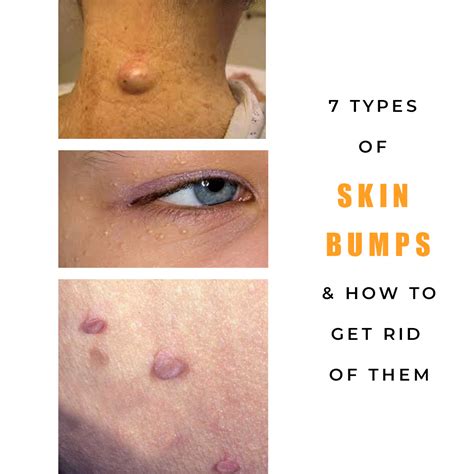 Recognizing the Different Types of Bumps