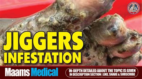 Recognizing the Signs of Jigger Infestation