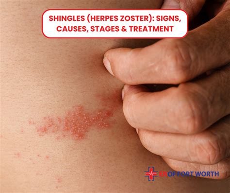 Recognizing the Symptoms What Does Shingles Look Like