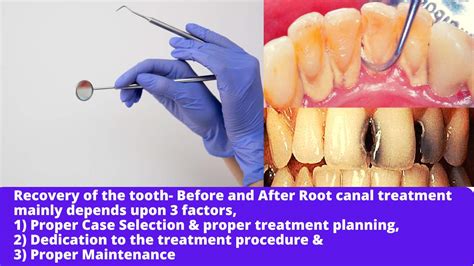Recovery after a root canal