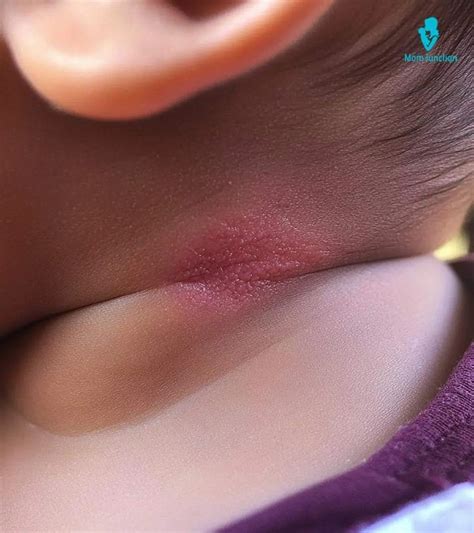 Red Baby Neck: Causes & Soothing Treatments