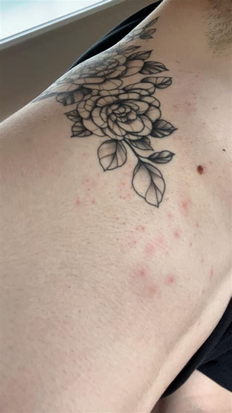Red Bumps On Tattoo