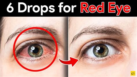 Red Eyes: Fast, Safe Relief & Solutions