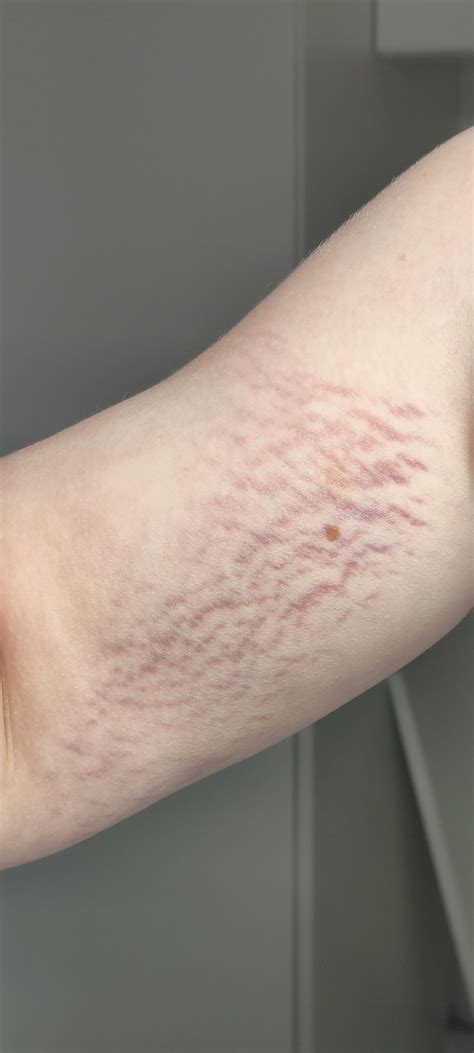 Unleashing the Truth Behind the Mysterious Red Lines on Skin After Sweating it Out: A Definitive Guide