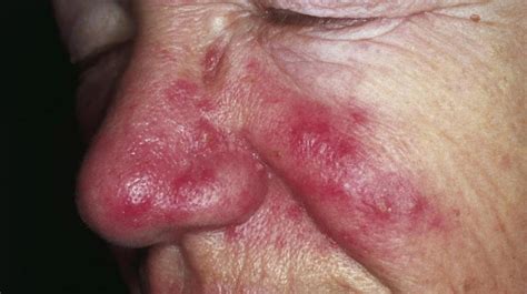 Unveiling the Mystery of Crimson Skin Under the Nasal Area: Causes, Symptoms, and Treatment Options