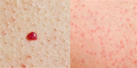 Unveiling The Mystery: Discover The Causes and Fixes of Red Spots on Skin after Intense Workouts