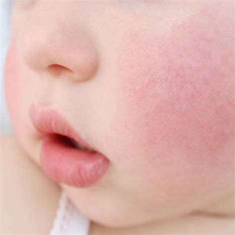 Say Goodbye to Redness on Your Baby's Cheeks with These Tips
