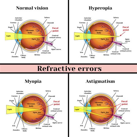 Refractive Errors