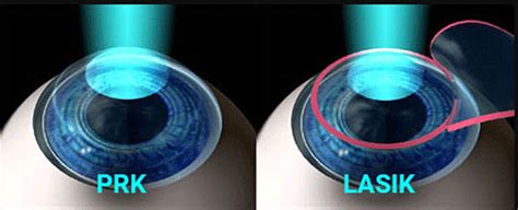 Refractive Surgery (LASIK and PRK) Options