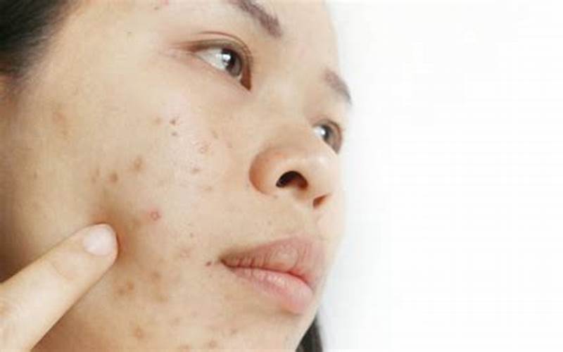 Rekomendasi Skincare Untuk Menghilangkan Bekas Jerawat Hitam
