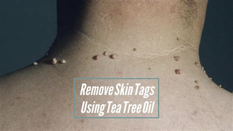 Banish Skin Troubles for Good! Discover the Miracles of Removing Skin Tags with Tea Tree Oil Now