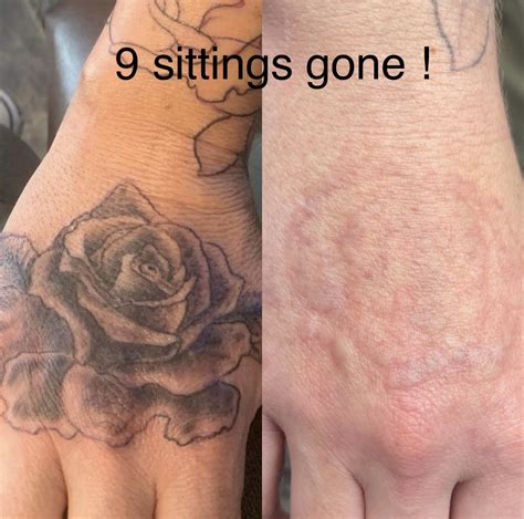 Tattoo Removal Treatment Laser