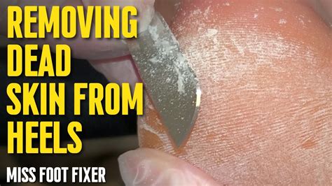 Say Goodbye to Dead Skin on Heels: Effective Removal Tips