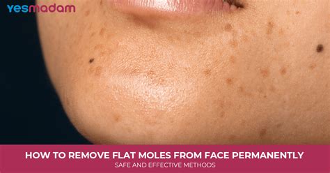 Remove Face Moles: Effective Methods & Solutions