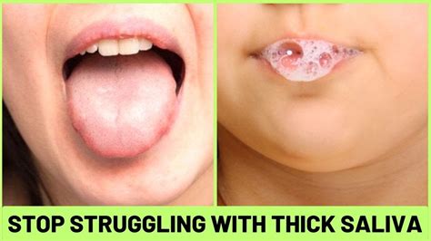 Say Goodbye to Skin Bridges with Saliva Treatment