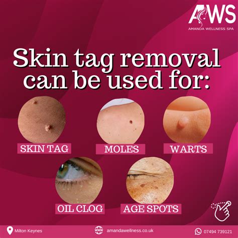 Say Goodbye to Frustration and Enjoy Flawless Skin: Your Expert Guide to Removing Skin Tags Safely