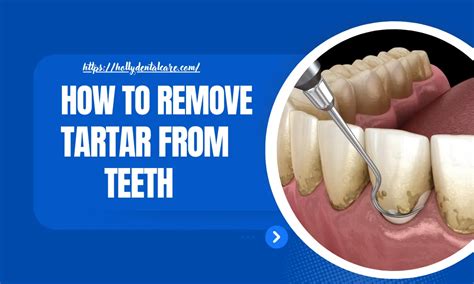Remove Tartar: 5 Simple Home Methods