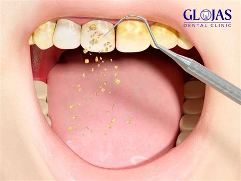 Remove Tartar: 6 Effective Methods