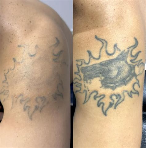 Remove Tattoo Near Me