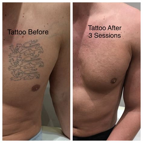 Tattoo Removal VoltaicPlasma Areton LTD
