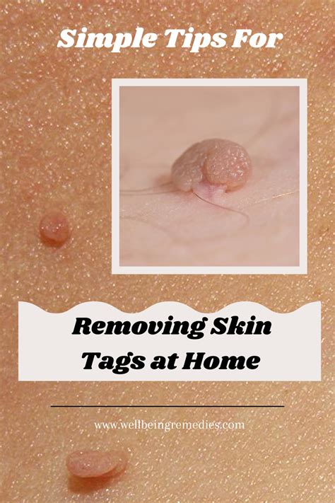 10 Easy Home Remedies to Banish Skin Tags for Good!