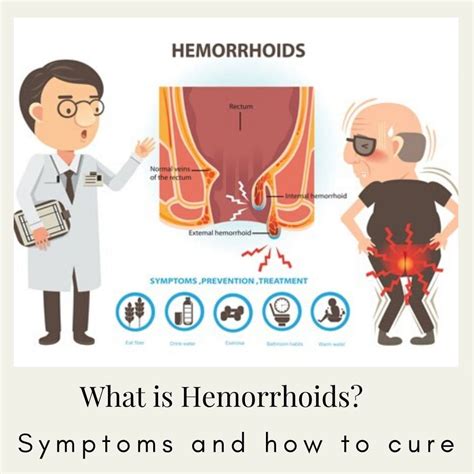 Surgery-free relief from the embarrassing remnants of hemorrhoids