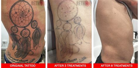 Rethink Before and After Laser Tattoo Removal Photos