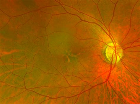 Retinal Pattern Dystrophy