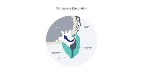 Retrograde Ejaculation and Fertility
