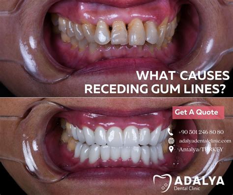 Reverse Receding Gums: Causes & Effective Treatments