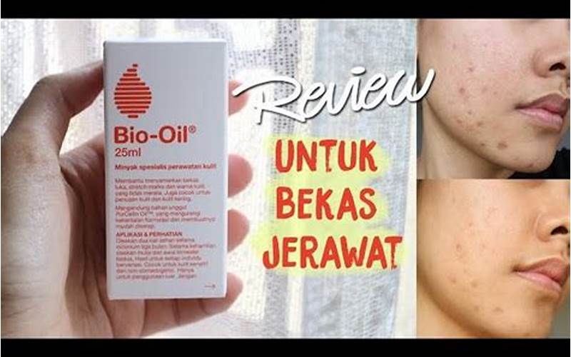 Review Bio Oil Untuk Jerawat