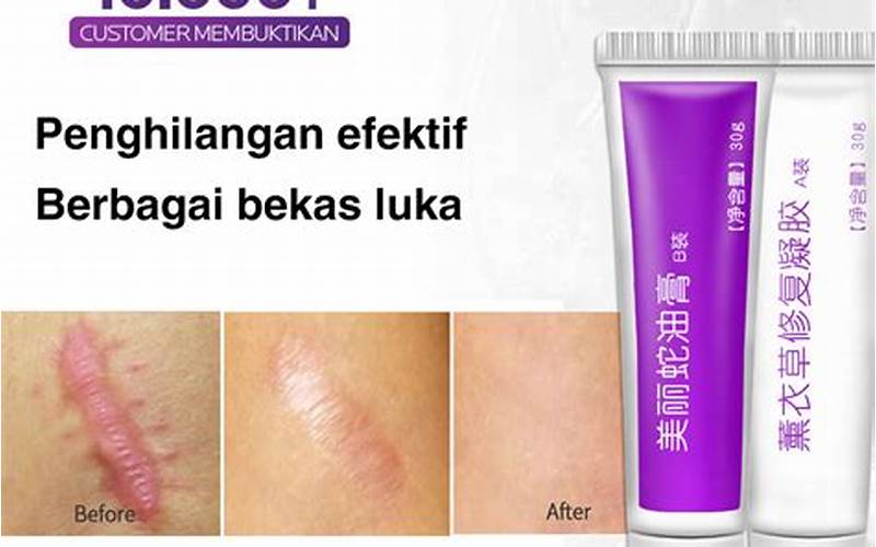 Review Cream Penghilang Bekas Jerawat