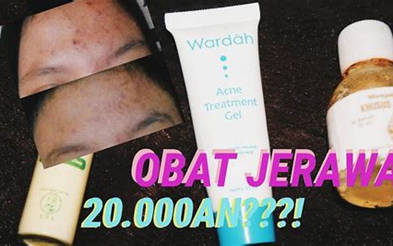 Review Obat Jerawat Paling Ampuh