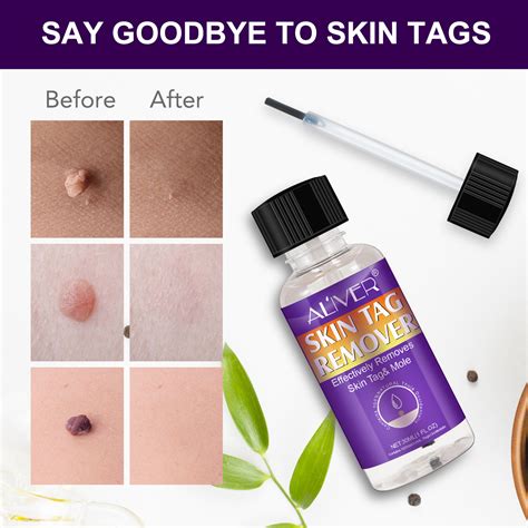 Regain Your Confidence with the Top-Rated and Pain-Free Skin Tag Remover - No More Embarrassment!