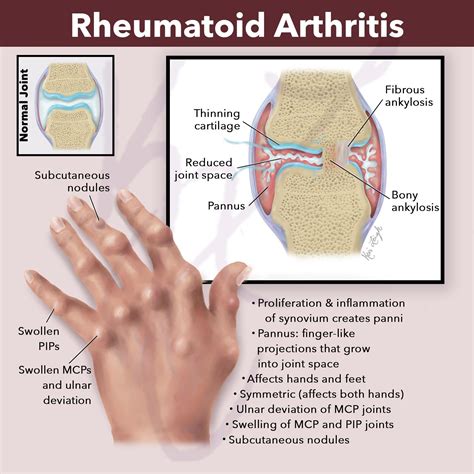 Rheum Arthritis