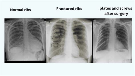 Rib Fractures: Risks, Recovery & Relief