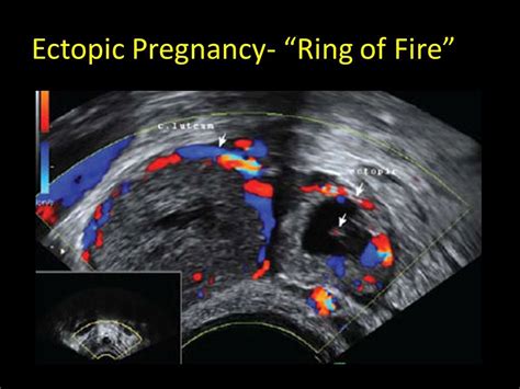 Ring Fire Ectopic