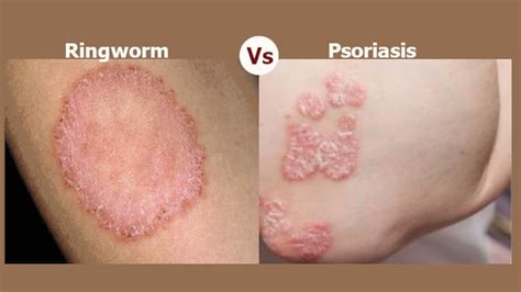 Ringworm vs. Psoriasis: Key Differences