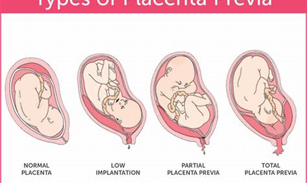 Risks and complications: placenta previa