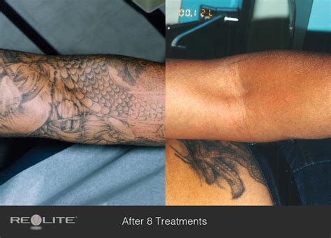 Change Is Not Regret Laser tattoo, Laser tattoo removal