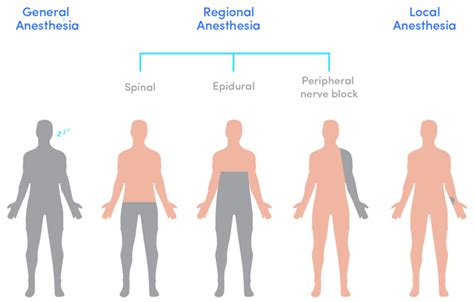 Risks of Regional Anesthesia